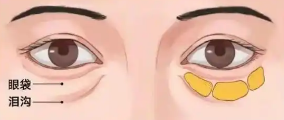 去眼袋手术