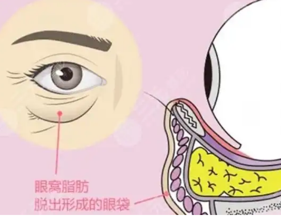 去眼袋手术