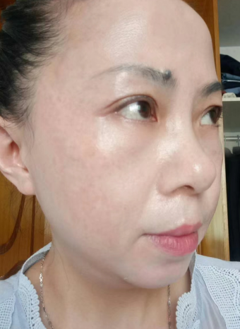 去眼袋手术