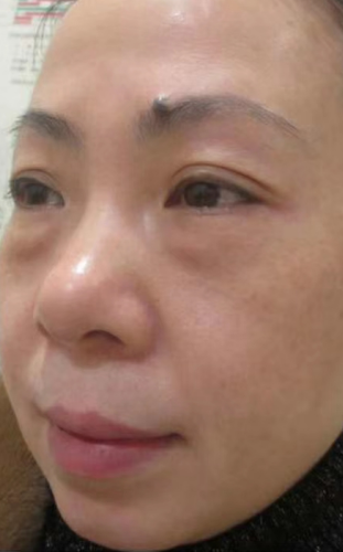 去眼袋手术