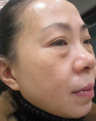去眼袋手术