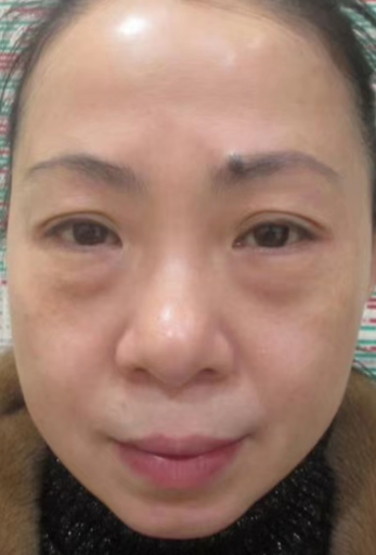 去眼袋手术