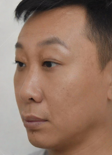 去眼袋手术