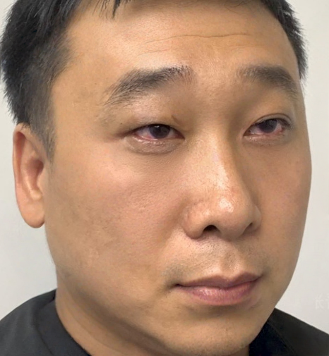 去眼袋手术