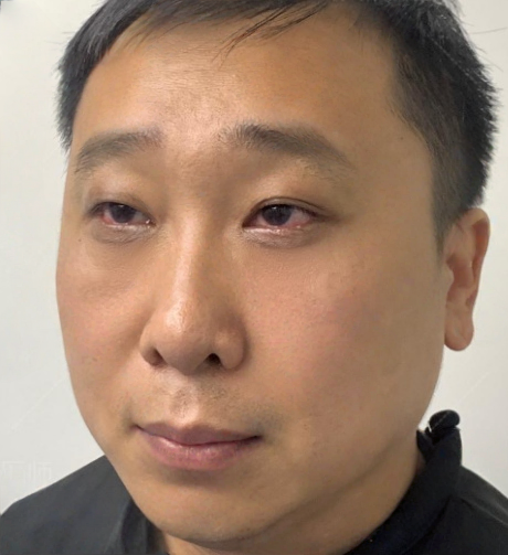 去眼袋手术
