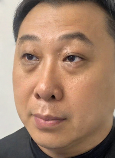 去眼袋手术