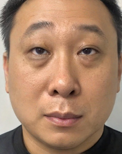 去眼袋手术