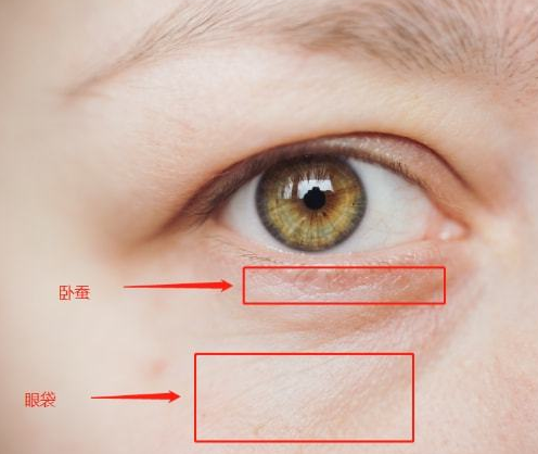 眼袋