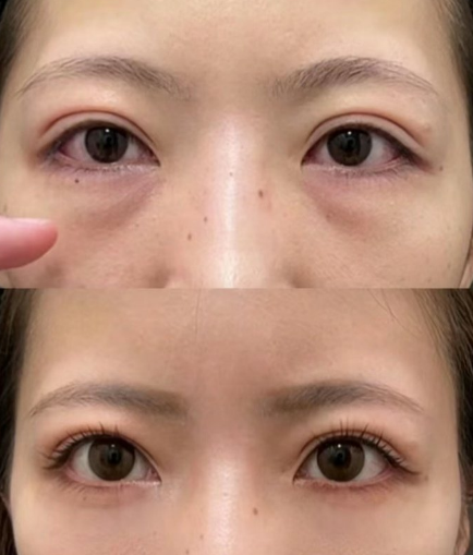 去眼袋手术