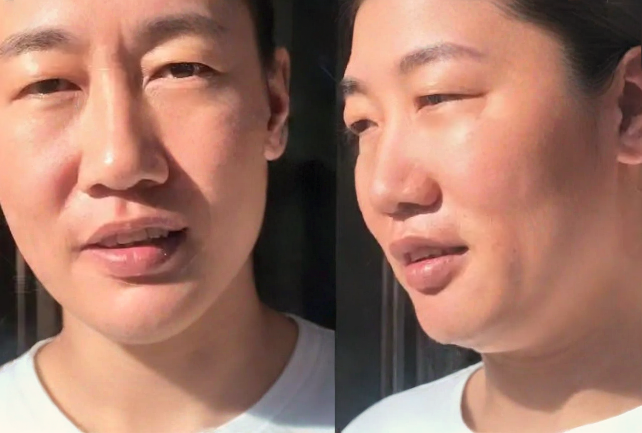 去眼袋手术