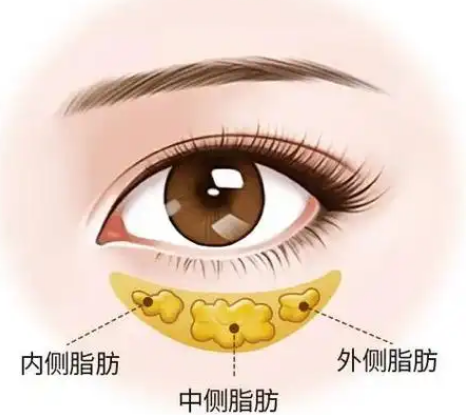 去眼袋手术