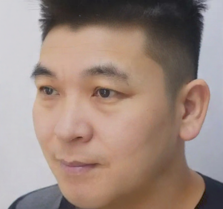 去眼袋手术