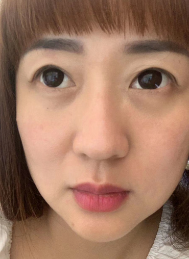 去眼袋手术