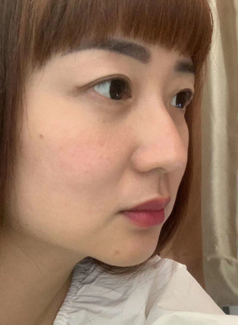 去眼袋手术