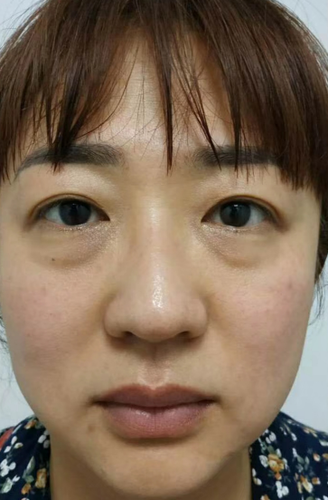 去眼袋手术