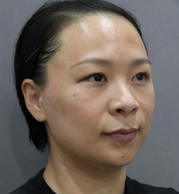 去眼袋手术