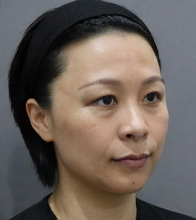 去眼袋手术
