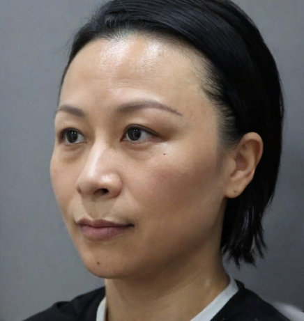 去眼袋手术