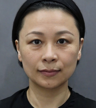 去眼袋手术