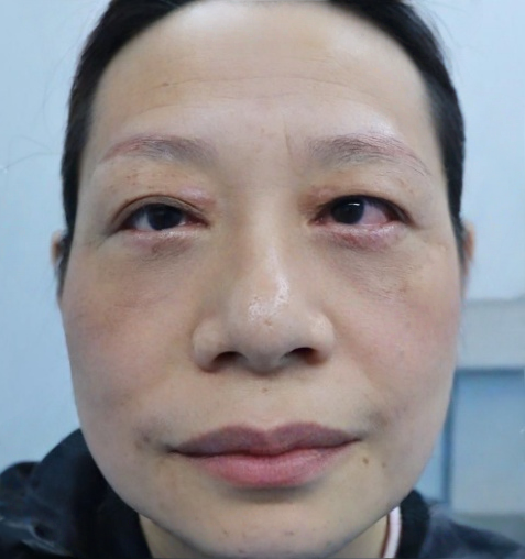 去眼袋手术