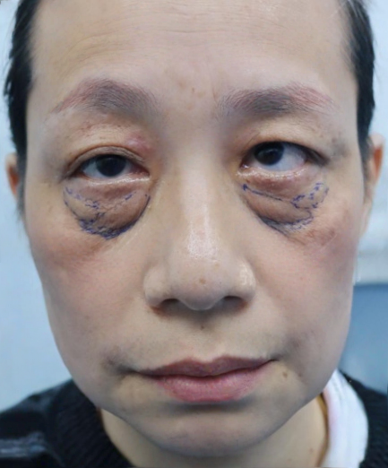 去眼袋手术