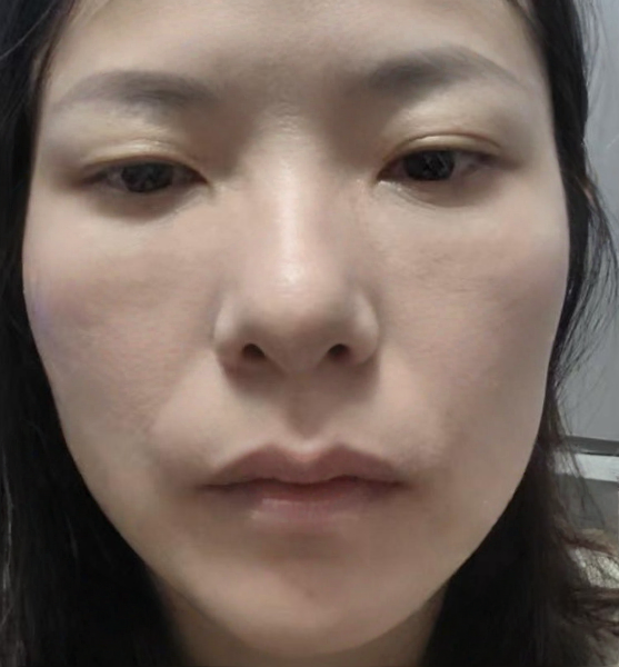 去眼袋手术
