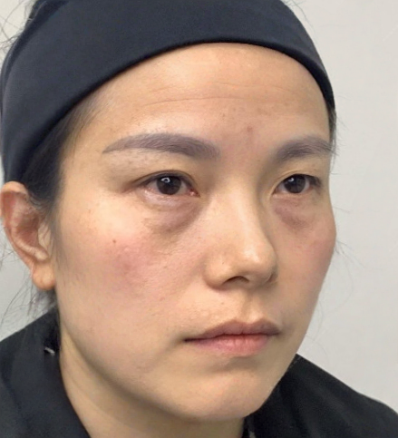 去眼袋手术