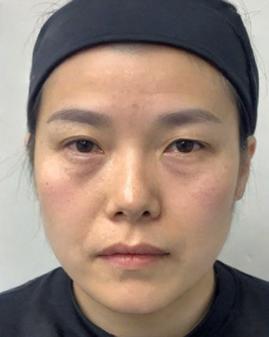 去眼袋手术