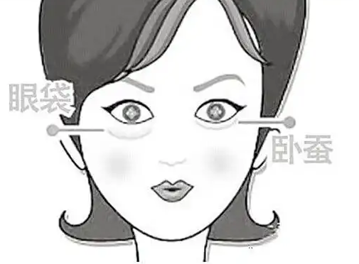 去眼袋手术