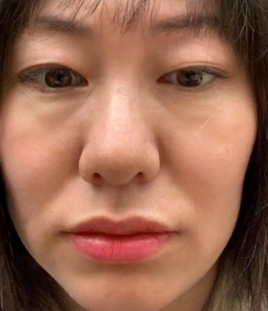 去眼袋手术