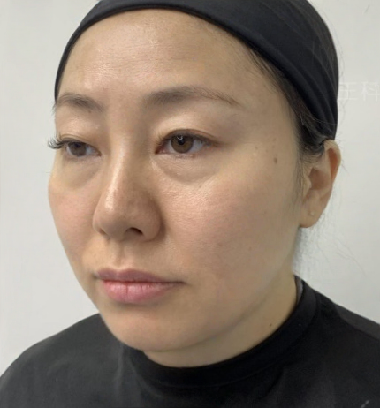 去眼袋手术