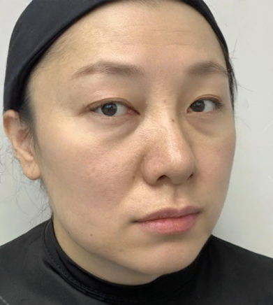 去眼袋手术