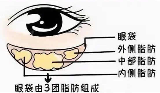 去眼袋手术