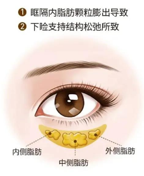 眼袋