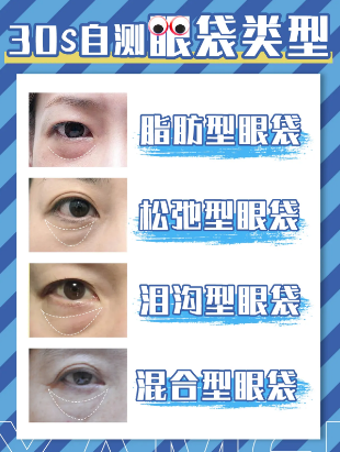 去眼袋手术