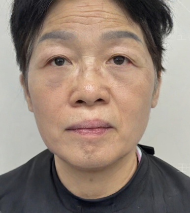 去眼袋手术