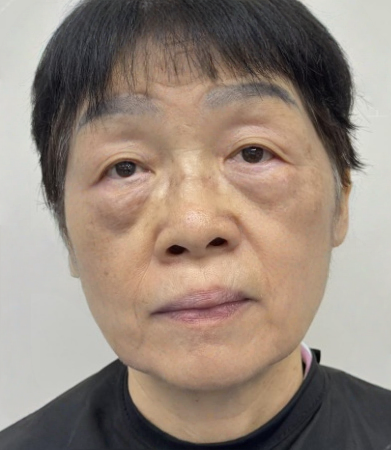 去眼袋手术