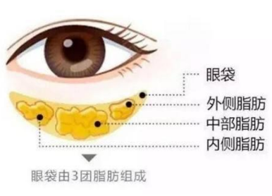 去眼袋手术