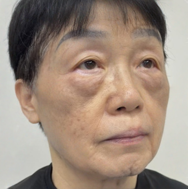 去眼袋手术