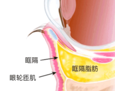 去眼袋手术