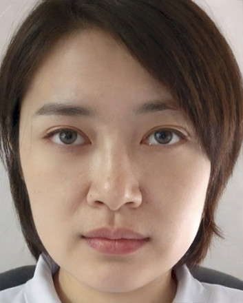 去眼袋手术