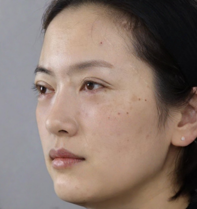 去眼袋手术