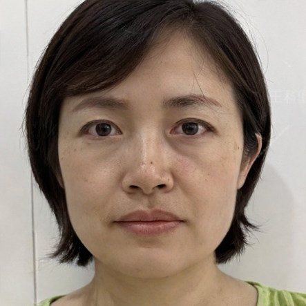 去眼袋手术