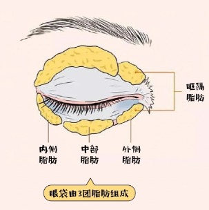 去眼袋手术