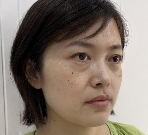 去眼袋手术