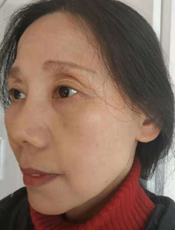 去眼袋手术