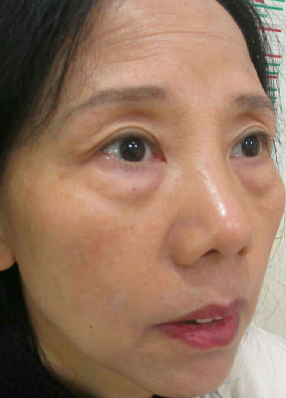 去眼袋手术