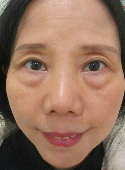 去眼袋手术