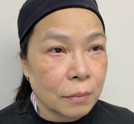 去眼袋手术