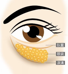 去眼袋手术